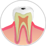 C1：歯の表面の虫歯