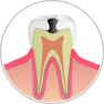 C2：歯の中の虫歯